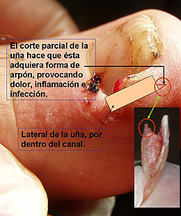 mal corte de una