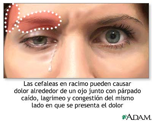 dolores de cabeza 