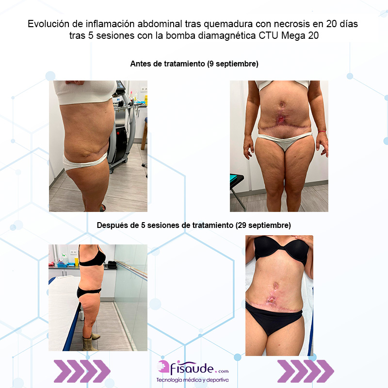 evolucion-inflamacion-abdominal-con-bomba-diamagnetica