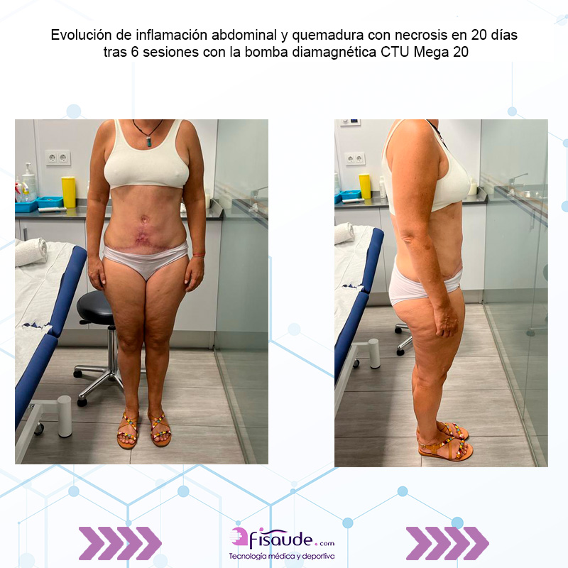 evolucion-inflamacion-abdominal-y-quemadura-con-bomba-diamagnetica