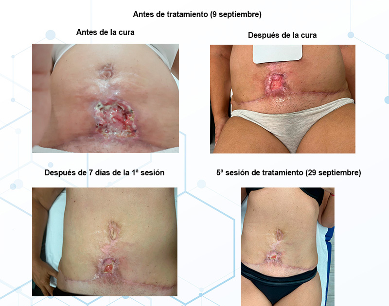 evolucion-quemadura-necrosis-con-bomba-diamagnetica