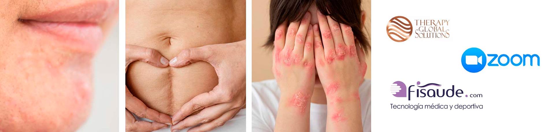 Diatermia radiofrecuencia en tratamientos estéticos y dermatofuncionales (Vía Zoom)