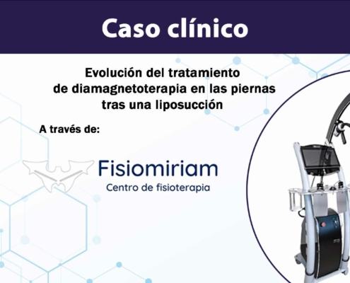 caso-clinico-bomba-diamagnetica-fisiomiriam-piernas-liposuccion-portada