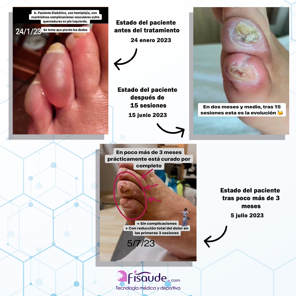 Caso clínico Cies Fisioterapia