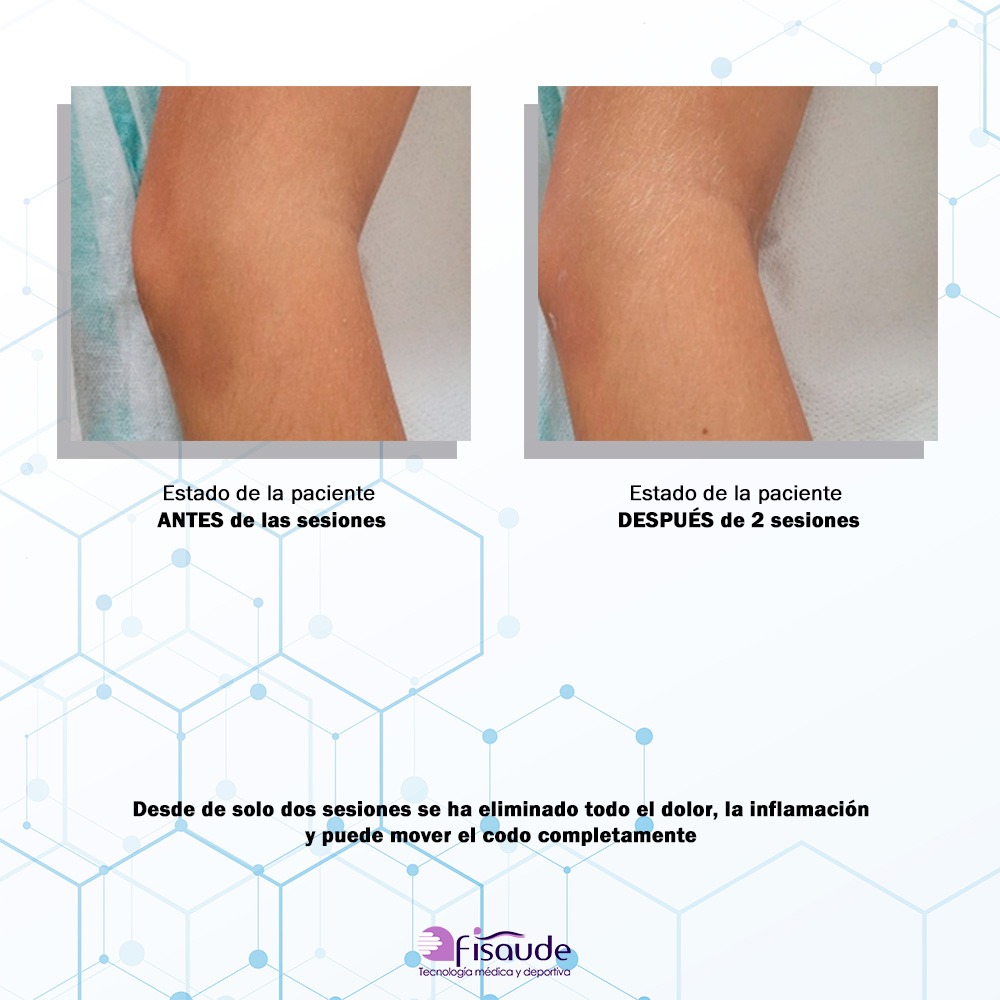caso clinico bomba diamagnetica fisiocenter traumatismo codo