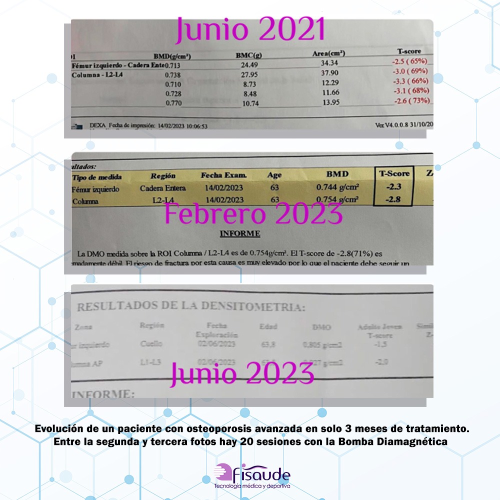 caso clinico bomba diamagnetica xanara osteroporosis