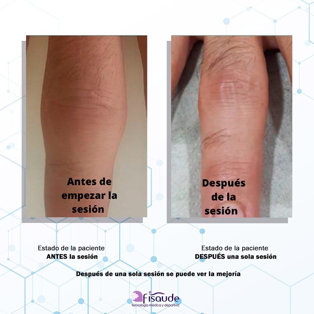 caso clinico bomba diamagnetica fisiomiriam capsulitis